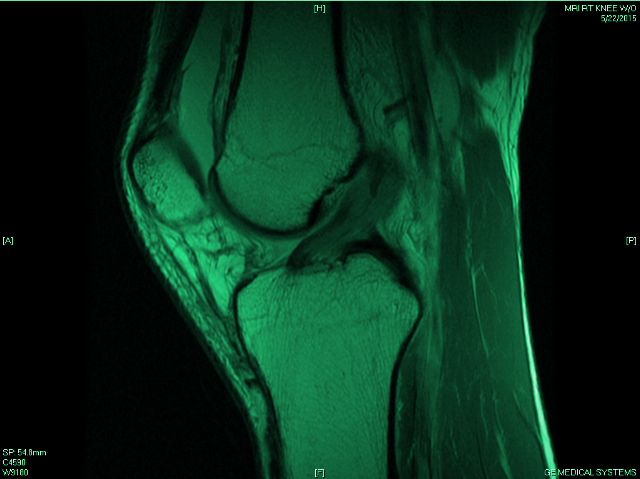 Recovering From Major Knee Surgery Without Ice